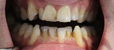 Before Invisalign Treatment Smile Rooms Glasgow