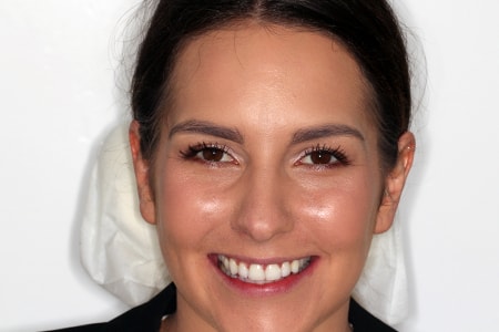 After Invisalign Treatment Smile Rooms Glasgow