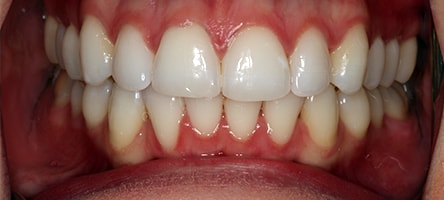 After Invisalign Treatment Smile Rooms Glasgow