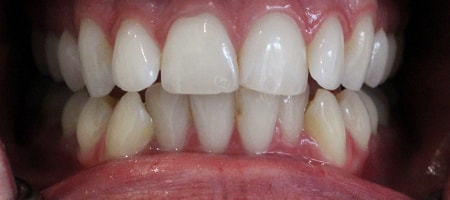 Before Invisalign Treatment Smile Rooms Glasgow