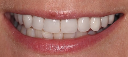 After Veneers Treatment Reading Smiles After Veneers Treatment Reading Smiles