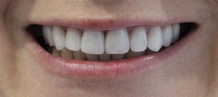 Before veneers Treatment Reading Smiles Before veneers Treatment Reading Smiles