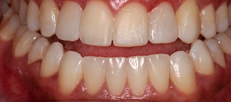 After Invisalign Treatment Smile Rooms Glasgow