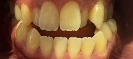 Before Invisalign Treatment Smile Rooms Glasgow