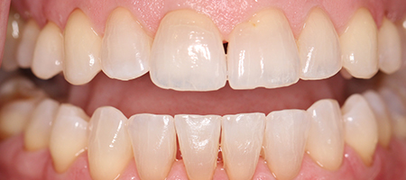 After Invisalign Treatment Smile Rooms Glasgow