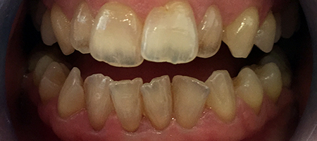Before Invisalign Treatment Smile Rooms Glasgow