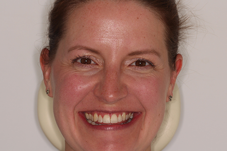 After Invisalign Treatment Smile Rooms Glasgow