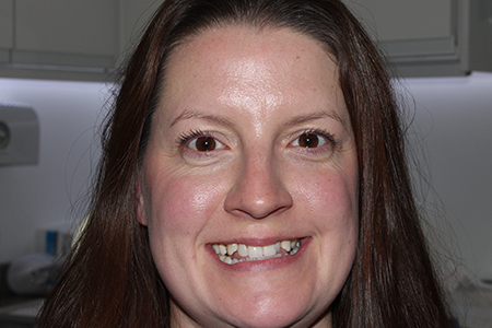 Before Invisalign Treatment Smile Rooms Glasgow