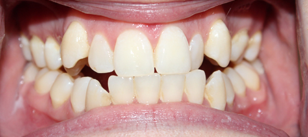 Before Invisalign Treatment Smile Rooms Glasgow