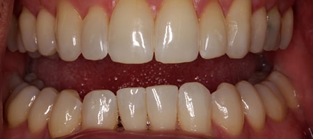 After Invisalign Treatment Smile Rooms Glasgow
