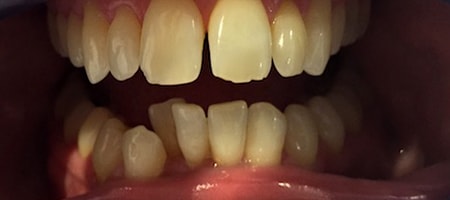 Before Invisalign Treatment Smile Rooms Glasgow