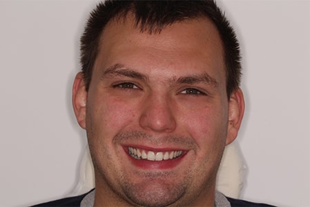 After Invisalign Treatment Smile Rooms Glasgow