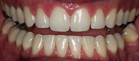 After Invisalign Treatment Smile Rooms Glasgow