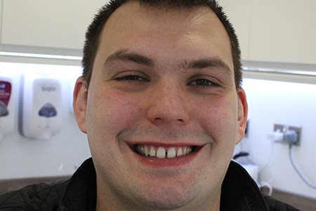 Before Invisalign Treatment Smile Rooms Glasgow