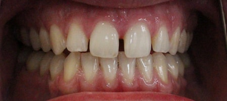 Before Invisalign Treatment Smile Rooms Glasgow