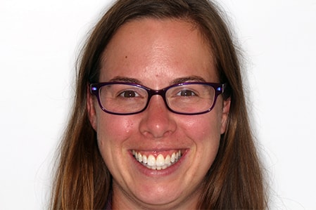 After Invisalign Treatment Smile Rooms Glasgow