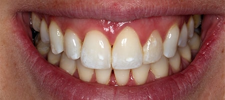 After Invisalign Treatment Smile Rooms Glasgow