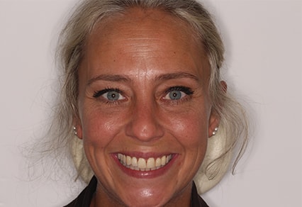 After Invisalign Treatment Smile Rooms Glasgow