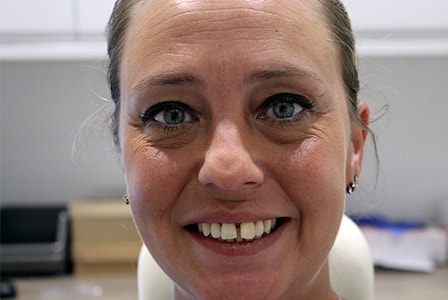 Before Invisalign Treatment Smile Rooms Glasgow