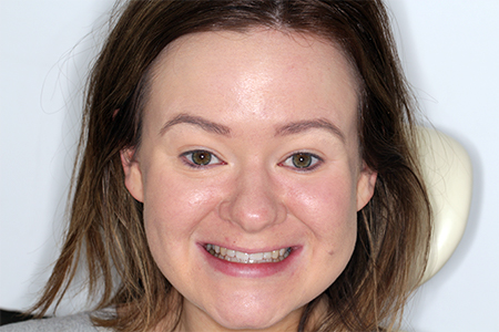 After Invisalign Treatment Smile Rooms Glasgow