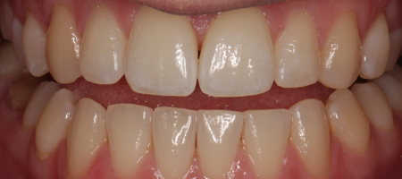 After Invisalign Treatment Smile Rooms Glasgow