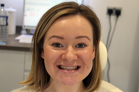 Before Invisalign Treatment Smile Rooms Glasgow
