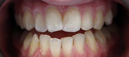 Before Invisalign Treatment Smile Rooms Glasgow
