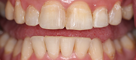 After Invisalign Treatment Smile Rooms Glasgow