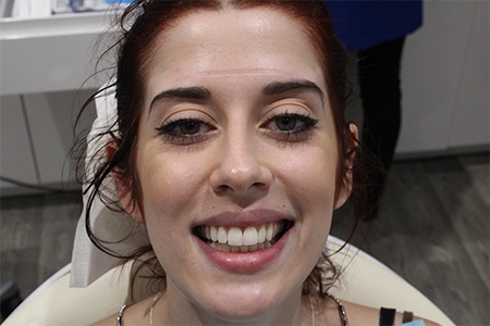 After Smile Makeover Treatment Reading Smiles 