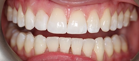 After Invisalign Treatment Smile Rooms Glasgow