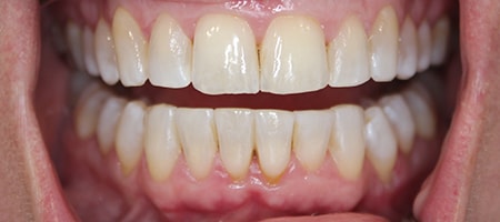 After Invisalign Treatment Smile Rooms Glasgow