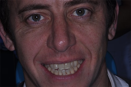 Before Invisalign Treatment Smile Rooms Glasgow