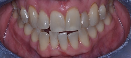 Before Invisalign Treatment Smile Rooms Glasgow