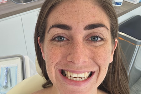 Before Invisalign Treatment Smile Rooms Glasgow