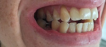 Before Invisalign Treatment Smile Rooms Glasgow