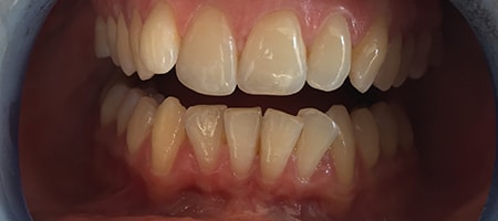 Before Invisalign Treatment Smile Rooms Glasgow