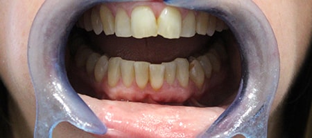 Before Invisalign Treatment Smile Rooms Glasgow
