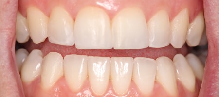 After Invisalign Treatment Reading Smiles 