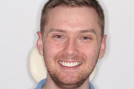 After Invisalign Treatment Smile Rooms Glasgow