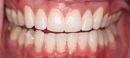 After Invisalign Treatment Smile Rooms Glasgow