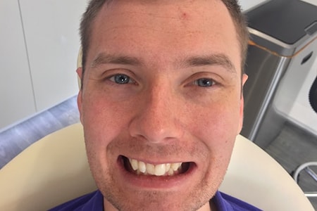Before Invisalign Treatment Smile Rooms Glasgow