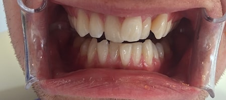 Before Invisalign Treatment Smile Rooms Glasgow