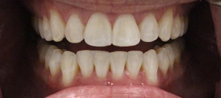 After Invisalign Treatment Smile Rooms Glasgow