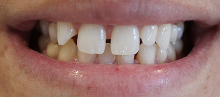 Before Invisalign Treatment Smile Rooms Glasgow