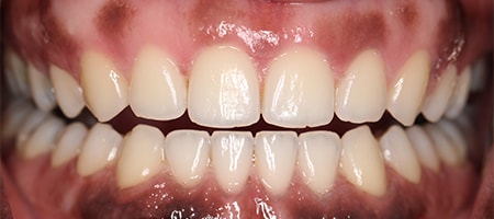 After Invisalign Treatment Smile Rooms Glasgow