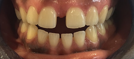 Before Invisalign Treatment Smile Rooms Glasgow
