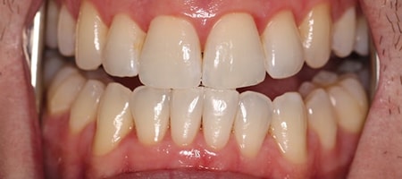 After Invisalign Treatment Smile Rooms Glasgow