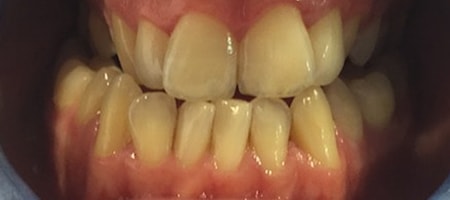 Before Invisalign Treatment Smile Rooms Glasgow