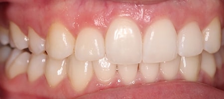 After Invisalign Treatment Smile Rooms Glasgow
