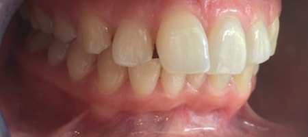Before Invisalign Treatment Smile Rooms Glasgow